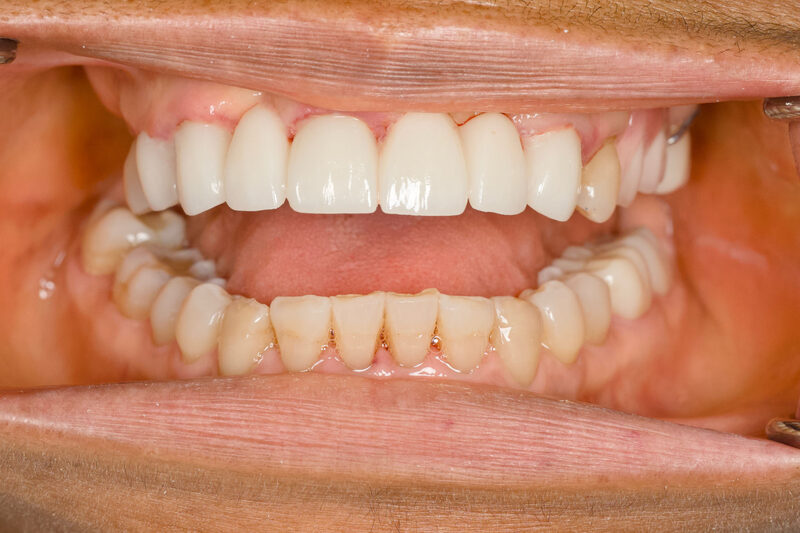 After: the same patient with a full row of natural-looking upper front teeth restored by Marshall H. Brown, DDS in Fort Worth