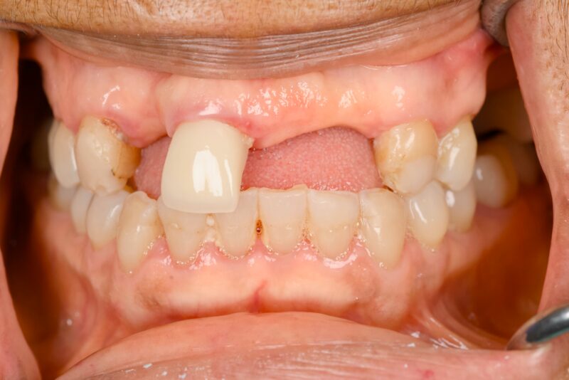 Before: patient with missing upper front teeth and a single worn crown, prior to treatment at Marshall H. Brown, DDS in Fort Worth