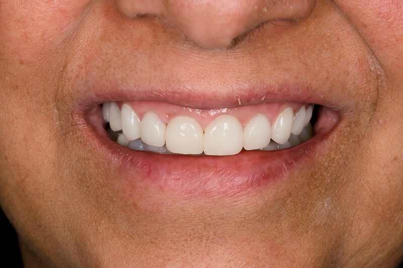 After: the same patient smiling with even, bright upper front teeth following a smile makeover at Marshall H. Brown, DDS