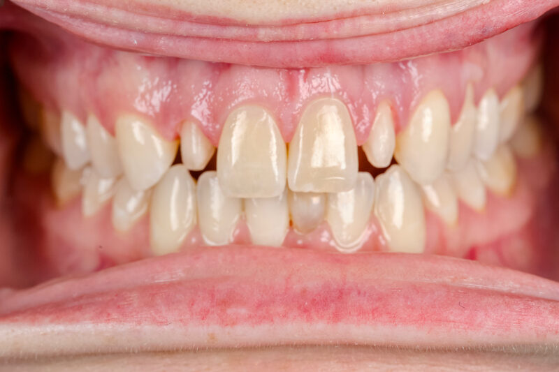 Before: patient with gaps, chipped edges, and discolored front teeth, prior to a smile makeover in Fort Worth